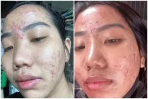 Minum produk kolagen malah breakout, perubahan kulit cewek ini endingnya bikin melongo