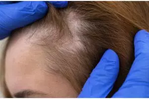 Tak perlu serum rambut, begini trik mudah tumbuhkan rambut pitak samping hanya pakai 2 bahan dapur