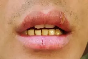 Tanpa produk pemutih, pakai bawang putih dicampur 1 jenis buah bisa atasi gigi bernoda kuning