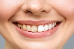 Gigi bersih tanpa plak, ini trik alami memutihkan gigi pakai 2 jenis buah