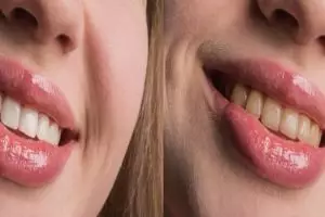 Tak perlu lemon, ini cara agar gigi kuning dan penuh plak kembali putih pakai 2 jenis buah