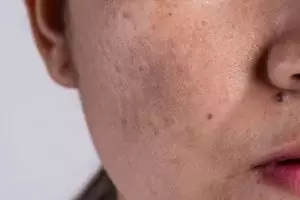 Tak perlu kopi dan lemon, begini cara pudarkan flek hitam akibat hiperpigmentasi pakai 1 jenis rempah