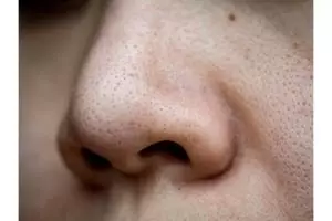 Bukan dengan madu, ini trik kecilkan pori-pori agar kulit kembali halus pakai 2 jenis minuman