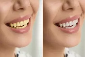 Tanpa baking soda, pasta gigi dicampur 1 jenis rempah ini bisa atasi plak dan gigi kuning