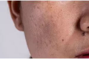 Tak perlu lemon, ini cara mencerahkan noda hitam di wajah agar auto glowing pakai 1 bumbu rempah