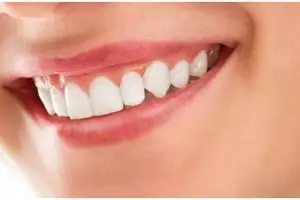 Bikin mulut segar dan bersih, begini cara hilangkan karang gigi hanya pakai 1 bahan alami