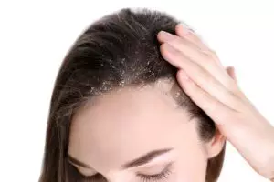 Sampo dicampur 1 jenis buah ini bisa atasi ketombe membandel, begini cara meracik dan menggunakannya