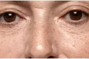 Tanpa laser, ini cara hilangkan flek hitam dan cerahkan wajah dengan 1 jenis buah