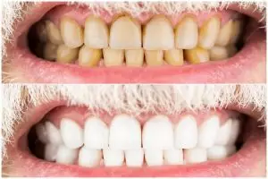 Andalkan satu jenis buah ini gigi kuning berkerak kembali putih, tanpa perlu menggunakan garam