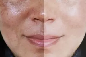 Bukan hanya air mawar, begini cara cerahkan flek hitam dan wajah kusam dengan tambahan 1 jenis buah