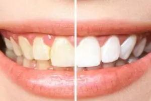 Napas kian segar, ini trik bersihkan plak dan bau mulut pakai obat kumur dari 2 jenis rempah