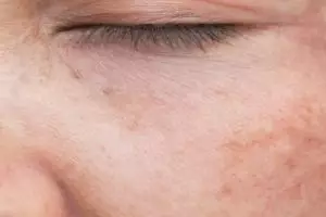 Cara memudarkan flek membandel pada wajah pakai 1 buah, tak perlu ditambah kunyit