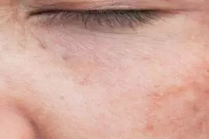 Bukan cuma air beras, ini cara hapus noda hitam gegara sering panas-panasan cuma pakai 1 kulit buah