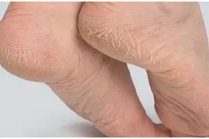 Nggak perlu pakai minyak zaitun, begini trik kembalikan tumit retak jadi halus dengan 1 jenis tepung