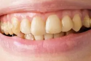 Bukan pakai garam dan baking soda, ini trik putihkan gigi kekuningan dengan 1 jenis ranting pohon