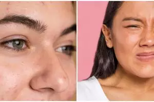 Cara sederhana hilangkan komedo di dahi dengan andalkan 2 jenis rempah, pori-pori jadi lebih bersih