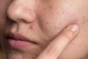 Cara menghilangkan beruntusan dengan andalkan 1 bahan pemanis, wajah jadi mulus bebas gradakan