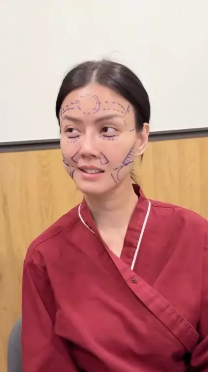 Nita Gunawan jalani transfer lemak © TikTok Nita Gunawan jalani transfer lemak © TikTok