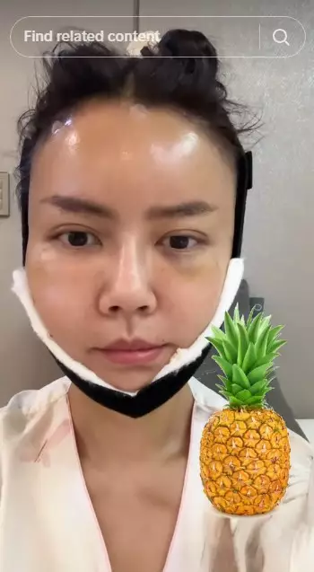 Nita Gunawan jalani transfer lemak © TikTok Nita Gunawan jalani transfer lemak © TikTok