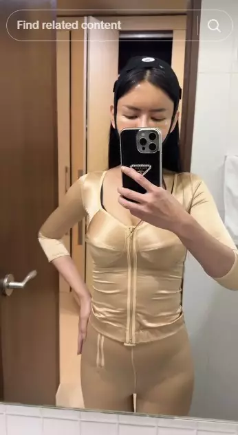 Nita Gunawan jalani transfer lemak © TikTok Nita Gunawan jalani transfer lemak © TikTok