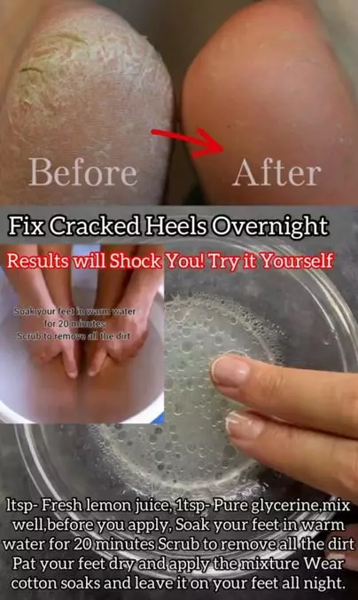 Haluskan tumit retak pakai 1 jenis buah-buahan Berbagai sumber