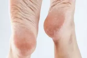 Cara simpel muluskan tumit kaki retak pakai 1 alat penerangan, dijamin mulus dalam sekejap