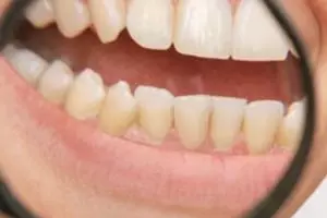 Cara merontokkan noda dan plak pada gigi pakai 1 jenis minyak esensial, tanpa baking soda