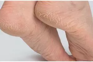  Bukan pakai petroleum jelly, ini cara haluskan tumit retak dan kasar cuma pakai 2 jenis minyak