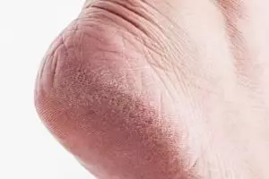 Cara bikin tumit kasar jadi mulus bebas pecah-pecah pakai 2 jenis buah, kaki auto bersih dalam sekejap