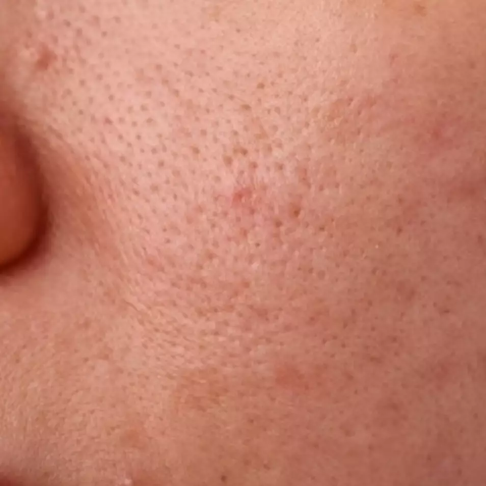 Cara bikin pori-pori besar jadi mulus tanpa bekas pakai 1 jenis sumber protein, nggak perlu skincare