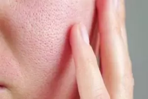 Nggak cuma air mawar, ini cara mengecilkan pori-pori kulit agar tak tersumbat pakai 1 sumber protein