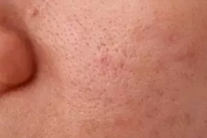 Cara kecilkan pori-pori agar wajah bebas minya pakai 1 bahan masak, nggak beli lagi beli porepack