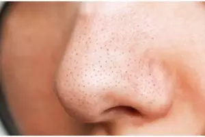 Cara mudah dan alami mengecilkan pori-pori wajah agar terlihat lebih mulus cuma dengan 1 jenis buah