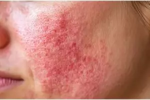 Cara mengatasi iritasi dan kemerahan di wajah ini ampuh bikin halus pakai masker dari 2 bahan dapur