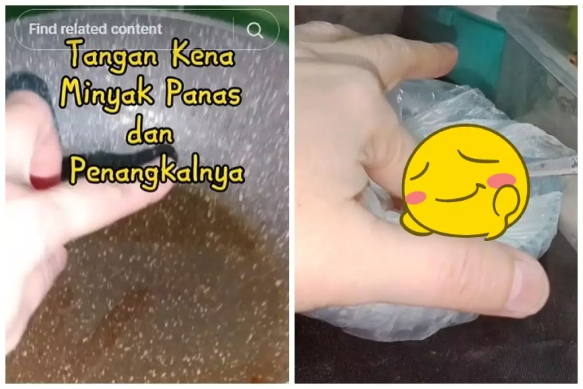 Trik agar kulit tak pedih dan melepuh saat terkena minyak panas, pakai 1 bahan dapur