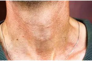 Jadi mulus tanpa lipatan, begini cara mencerahkan leher dekil pakai tambahan 1 bahan minuman