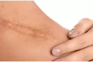 Tanpa diolesi salep, ini cara menghilangkan bekas luka secara alami pakai tambahan 1 bahan dapur