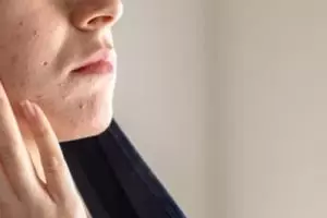 Cara bikin pori-pori mengecil agar kulit tampak mulus cuma dengan 1 kulit buah, bukan pakai bubuk kopi