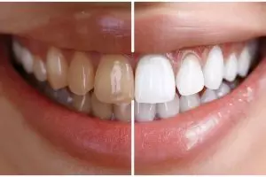 Cara mudah memutihkan gigi dalam 5 menit secara alami tanpa baking soda, cukup pakai 2 bahan dapur