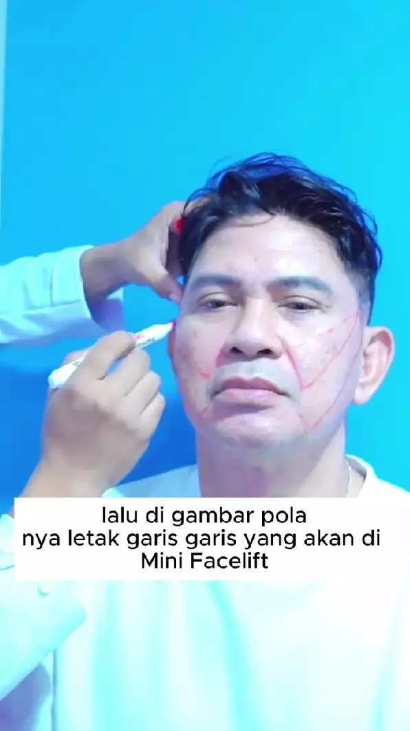 Momen Ronnie Sianturi jalani oplas © Instagram Momen Ronnie Sianturi jalani oplas © Instagram