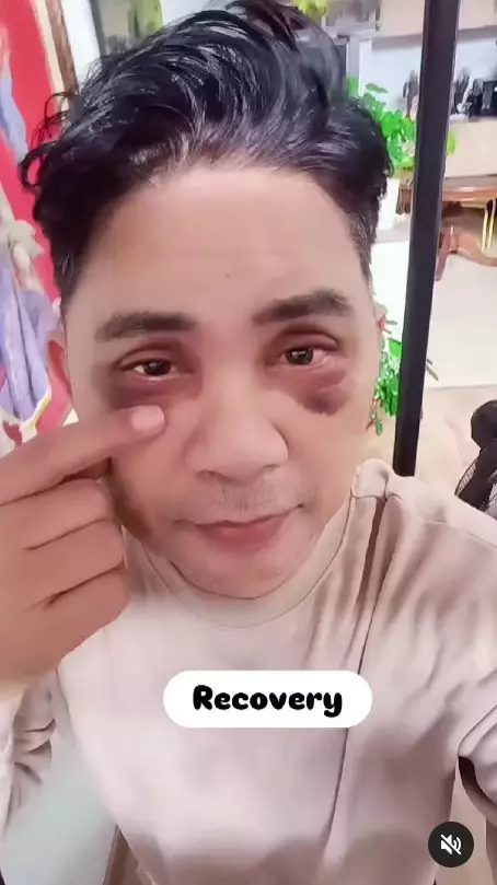 Momen Ronnie Sianturi jalani oplas © Instagram Momen Ronnie Sianturi jalani oplas © Instagram