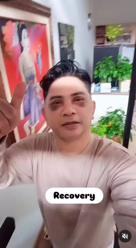 Momen Ronnie Sianturi jalani oplas © Instagram Momen Ronnie Sianturi jalani oplas © Instagram