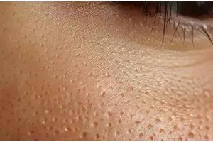 Cara mudah mengecilkan pori-pori tanpa dikompres es batu, cukup pakai masker dari 1 jenis buah ini