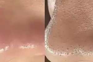 Cara bersihkan pori-pori tersumbat penyebab komedo pakai 1 jenis tepung, tanpa lemon dan kopi 