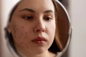 Cara atasi jerawat dan pori-pori besar pakai 1 jenis bahan minuman, bukan pakai kopi