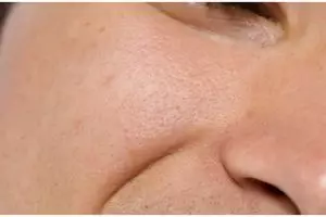 Cara bikin pori-pori rapat dan bersih cuma pakai 2 bahan dapur, bukan pakai lidah buaya