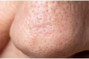 Tanpa air jeruk nipis, ini cara alami mengecilkan pori-pori lebar tanpa bikin wajah perih