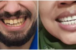 Cara mudah memutihkan gigi yang menguning agar tampak lebih cerah cuma dengan 1 bahan dapur