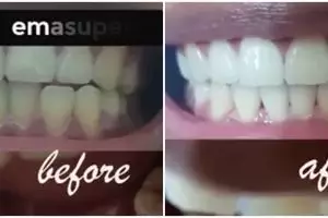 Cara alami memutihkan gigi dan menghilangkan karang ini bikin kinclong alami cuma dalam 3 hari