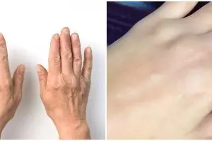 Cara atasi kulit tangan kering dan keriput ini bikin kencang, butuh minyak kelapa dan 3 bahan dapur